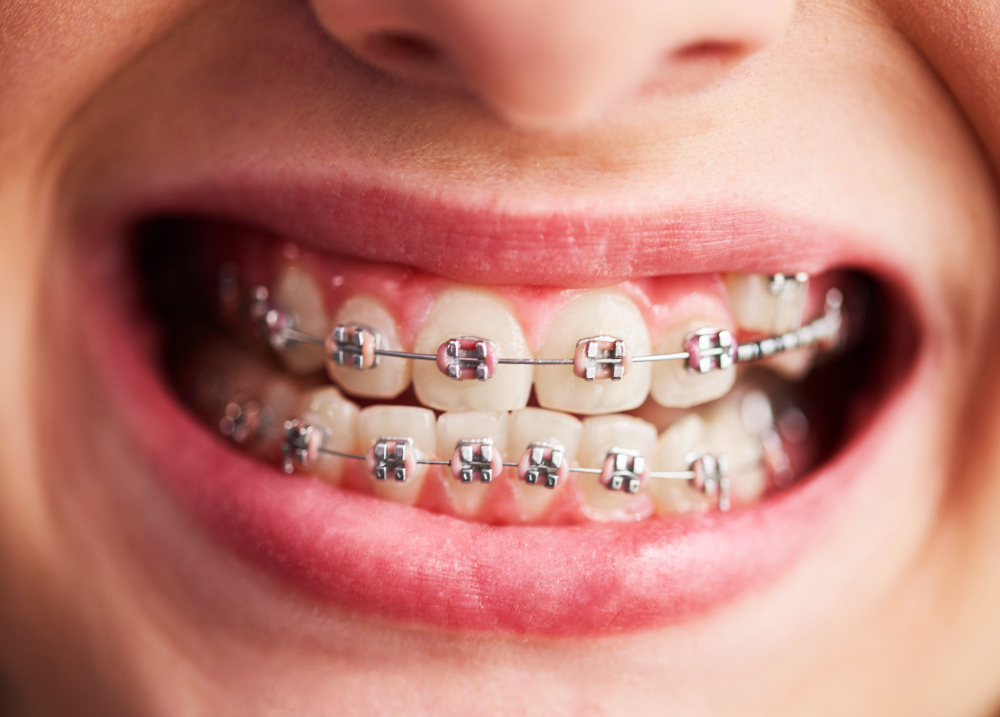 Sourire avec appareil orthodontique à bagues
