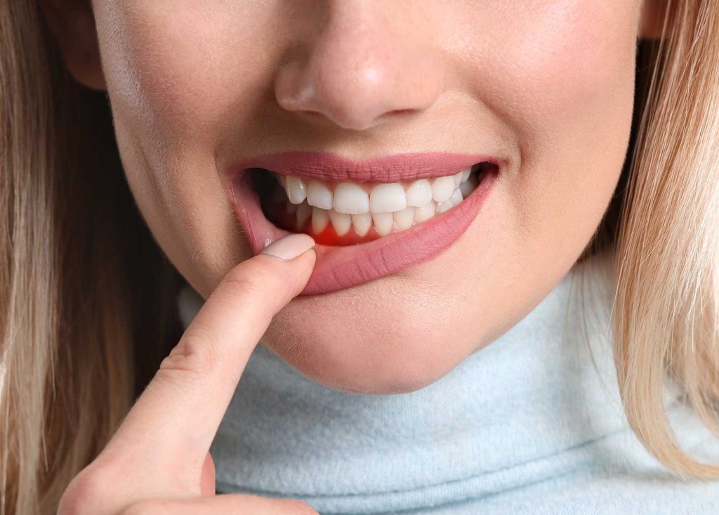 Femme montrant une inflammation gingivale, nécessitant un traitement parodontal ou une greffe de gencive à Genève.