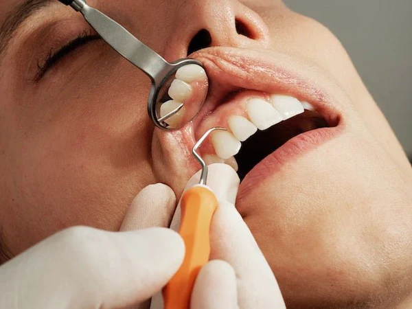 Un patient reçoit un détartrage dentaire professionnel chez son dentiste, éliminant le tartre et préservant la santé des dents et des gencives.