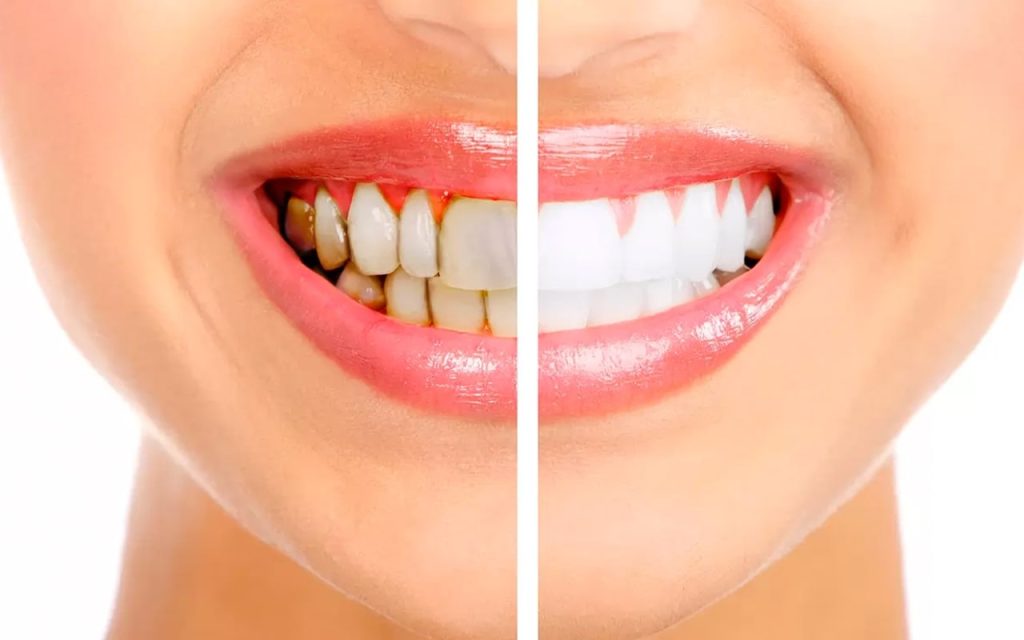 Comparaison avant et après un détartrage dentaire montrant l’efficacité du nettoyage professionnel pour des dents saines et blanches.